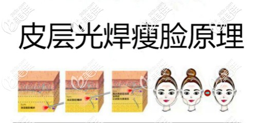 皮層光焊術(shù)原理