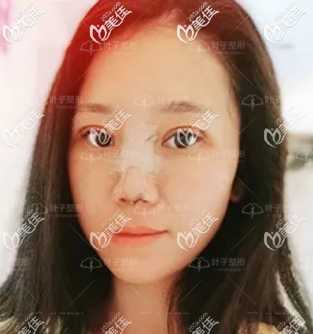 肋軟骨綜合隆鼻第四天效果 肋軟骨綜合隆鼻第四天效果