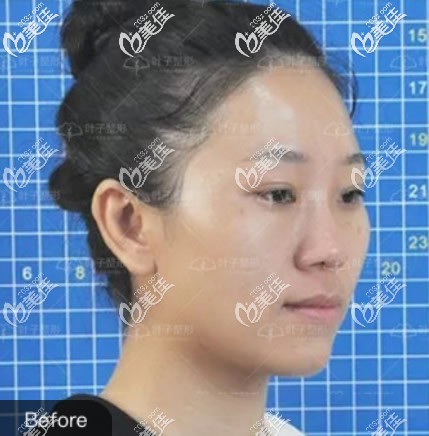 包頭葉子整形醫(yī)院肋軟骨隆鼻前 包頭葉子整形醫(yī)院肋軟骨隆鼻前