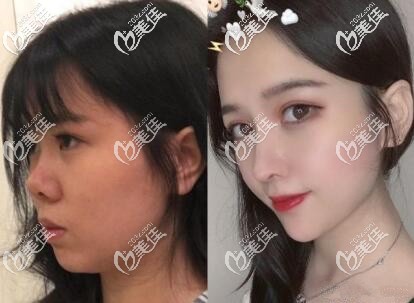 北京薇琳劉勇鼻綜合案例 北京薇琳劉勇鼻綜合案例