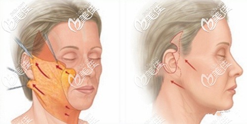 小切口提升術(shù)原理 小切口提升術(shù)原理