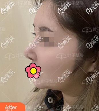 我膨體隆鼻排異取出假體后,第二次做鼻子用的是自體肋軟骨,硅膠假體根本不敢用!