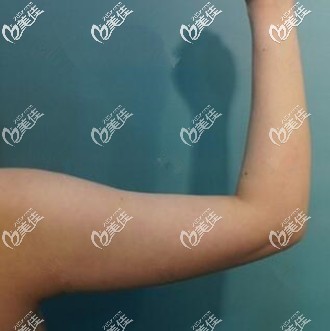 威塑吸脂瘦手臂術前照 威塑吸脂瘦手臂術前照