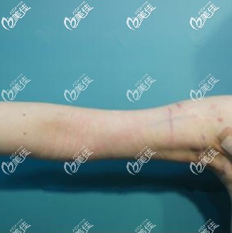 威塑吸脂瘦手臂術后當天照 威塑吸脂瘦手臂術后當天照