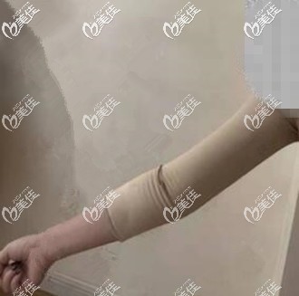 威塑吸脂瘦手臂術后一周恢復效果照 威塑吸脂瘦手臂術后一周恢復效果照