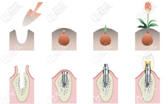 聽小區(qū)張姨說在西安未央?yún)^(qū)的中諾牙科做半口種植牙,價格才2萬多元？
