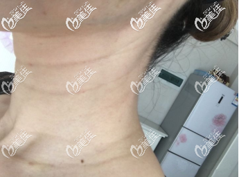 打完第三天 打完第三天