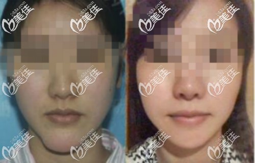 下巴打生長因子取出真人案例