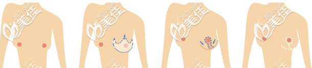 乳房懸吊術(shù)棒棒糖切口圖