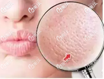 皮秒可以收縮毛孔