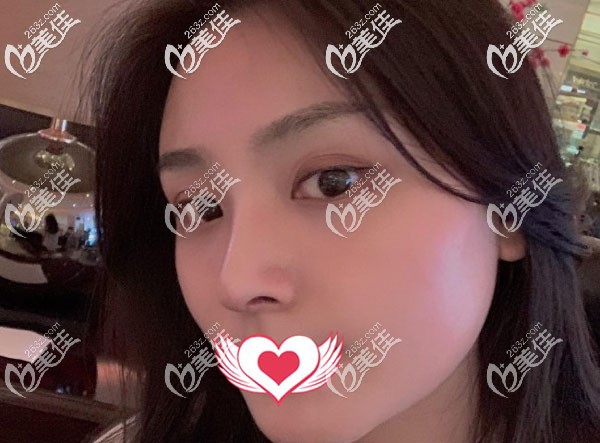 選擇哪種隆鼻方法很重要，看我肋骨隆鼻6個(gè)月恢復(fù)圖效果美到爆