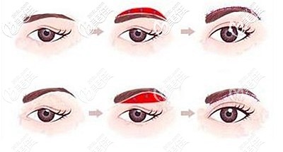 提眉手術(shù)的原理和維持時(shí)間 提眉手術(shù)的原理和維持時(shí)間
