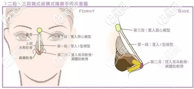 鼻假體放置的位置