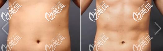 威塑吸脂瘦腰腹部真人前后對比照 威塑吸脂瘦腰腹部真人前后對比照