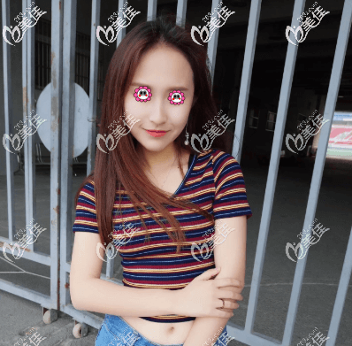 不開刀降低顴骨半個月了