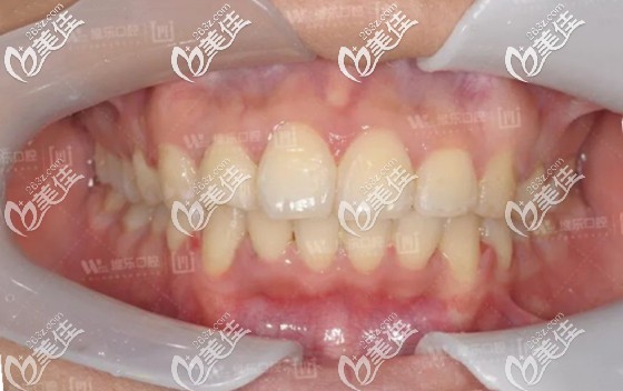 雙側(cè)推磨牙向后再配合正畸支抗釘?shù)淖饔?終使我的個別牙反頜恢復正常!