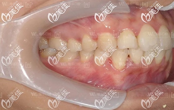 在北京維樂(lè)口腔做完矯正，反頜牙成功歸位