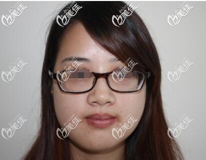 咬合不正、下頜偏移7毫米的她求助了醫(yī)生，術(shù)后2周有了明顯的蛻變