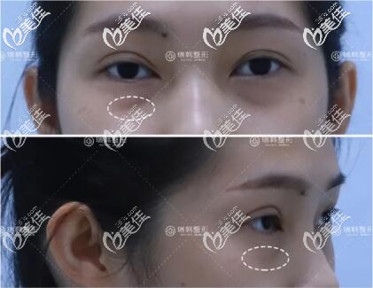 去眼袋術(shù)前照片 去眼袋術(shù)前照片