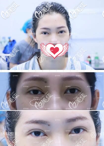 在瑞海去眼袋術(shù)后即刻效果照 在瑞海去眼袋術(shù)后即刻效果照