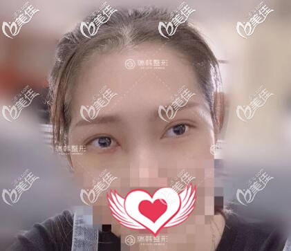 在海南做去眼袋術(shù)后一周效果照 在海南做去眼袋術(shù)后一周效果照