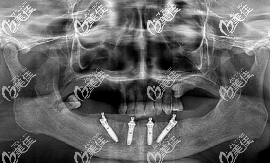 從網(wǎng)上找的別人做allon4下半口片子，其中2顆植體是斜著植入