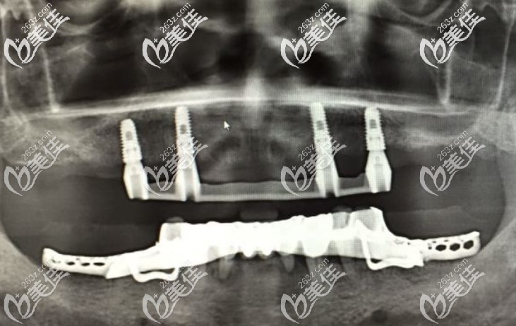 allon4上半口種植，種植體基本都是垂直植入