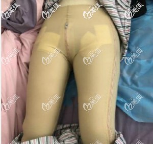 大腿和臀部抽脂一起做，第7天來(lái)醫(yī)院拆線