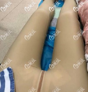 大腿+臀部抽脂術(shù)后45天恢復(fù)效果