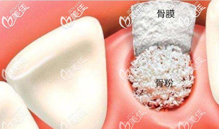牙科骨粉骨膜示意圖
