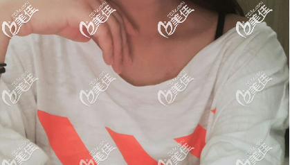 濟(jì)南藝星假體隆胸前的照片 濟(jì)南藝星假體隆胸前的照片