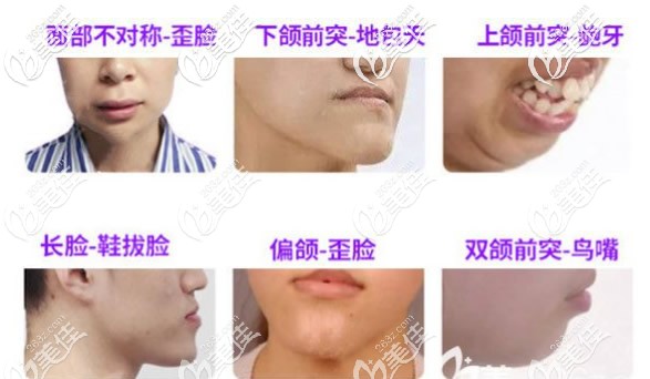 哪些人需要做正頜手術(shù)