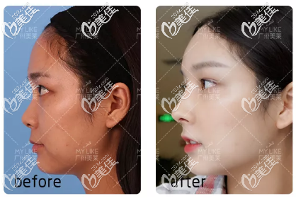 廣州美萊<!--<i data=20240703-sp></i>-->做鼻子的案例圖片 廣州美萊<!--<i data=20240703-sp></i>-->做鼻子的案例圖片