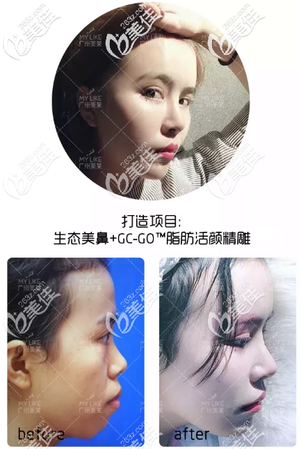 這就是<!--<i data=20240703-sp></i>-->做的鼻子案例圖片