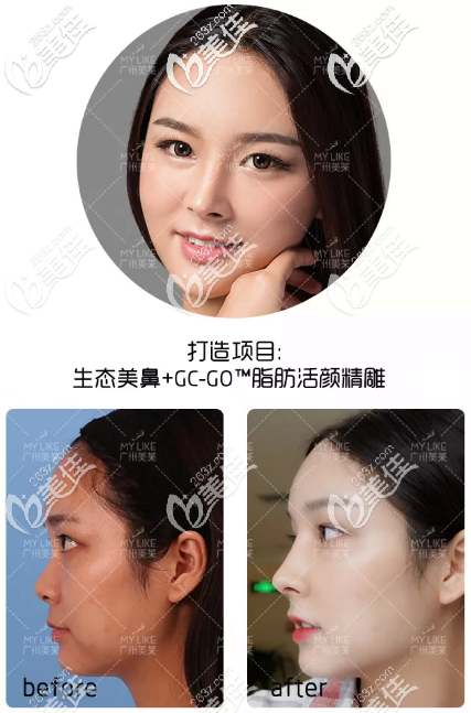 廣州美萊做鼻子88000元起,超多做的鼻子案例圖片可參考