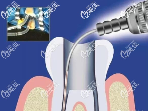 水激光治療技術