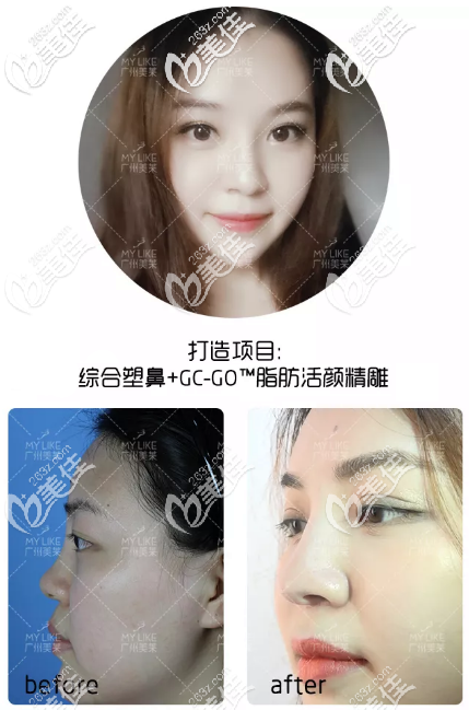 看我找<!--<i data=20240703-sp></i>-->做的鼻子怎么樣