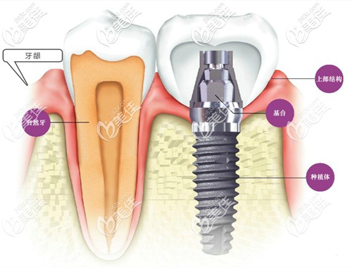 種植牙的示意圖 種植牙的示意圖