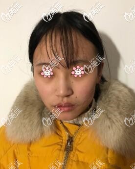 重慶華美嘴角上揚微笑唇術(shù)后半個月 重慶華美嘴角上揚微笑唇術(shù)后半個月