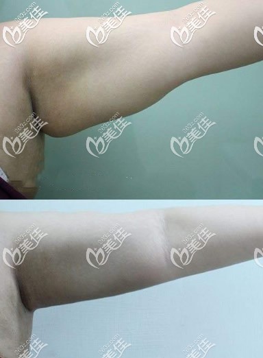 蝴蝶袖手臂抽脂后圖片