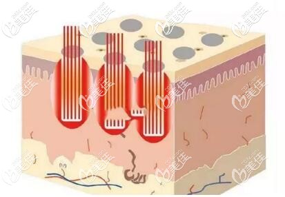 點陣激光去痘坑的作用