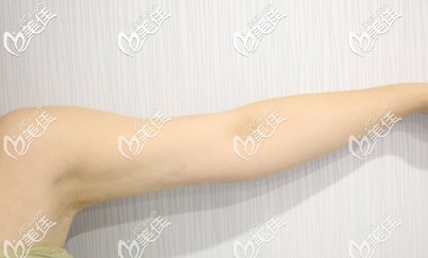 包頭華美做手臂環(huán)吸三個(gè)月效果圖