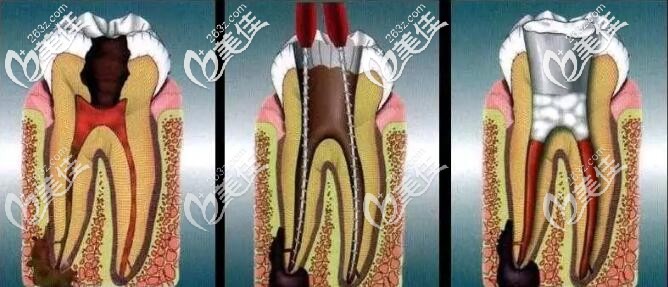牙齒根管治療 牙齒根管治療