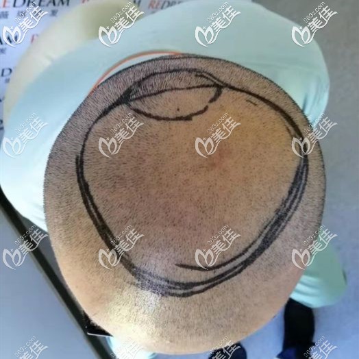 頭發(fā)都剃掉我我頭頂看起來也禿了一大塊