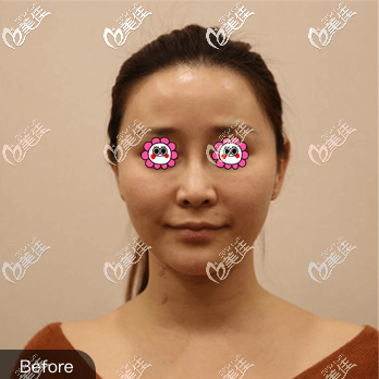 我做一針降顴骨前 我做一針降顴骨前