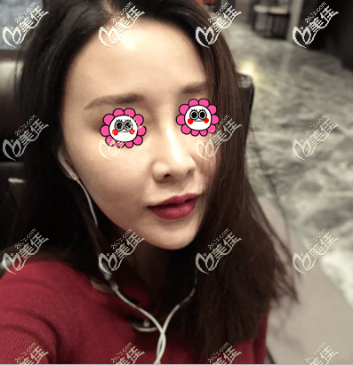 我做了一針降顴骨效果還可以,沒有出現(xiàn)感覺臉變更大的現(xiàn)象,還是挺靠譜的