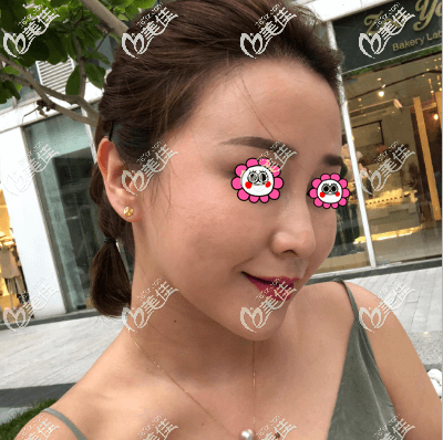 我做一針降顴骨后臉感覺沒有出現(xiàn)更大的現(xiàn)象效果還可以 我做一針降顴骨后臉感覺沒有出現(xiàn)更大的現(xiàn)象效果還可以