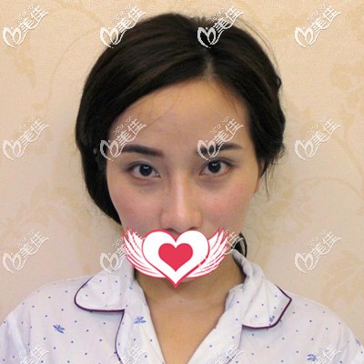 面部做埋線提升前的我 面部做埋線提升前的我