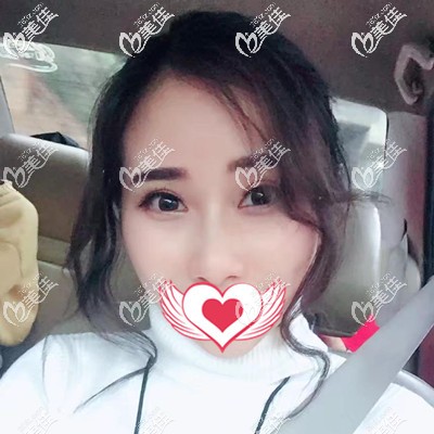 術(shù)后半個(gè)月效果 術(shù)后半個(gè)月效果