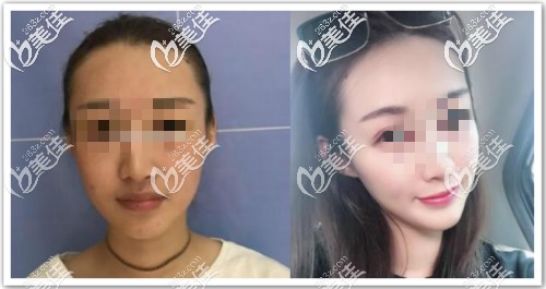 真人案例:八爪魚面部提升三個月效果對比 真人案例:八爪魚面部提升三個月效果對比